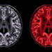 Brain Scan Study Reveals How Gluten Can Attack the Cerebellum in Two Very Different Ways