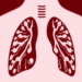 Drug-Resistant Tuberculosis Clones Are Quietly Spreading Beyond Their Historic Heartlands