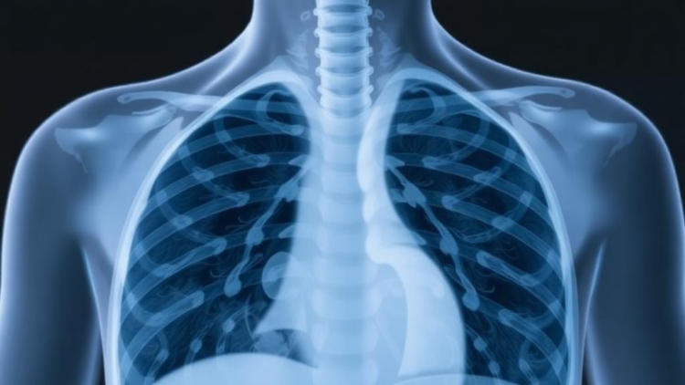 Four Simple Measures May Predict Who Survives Bacterial Pneumonia