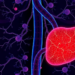 Adding Liver-Directed Therapy to Immunotherapy Doubles Survival in Advanced Liver Cancer