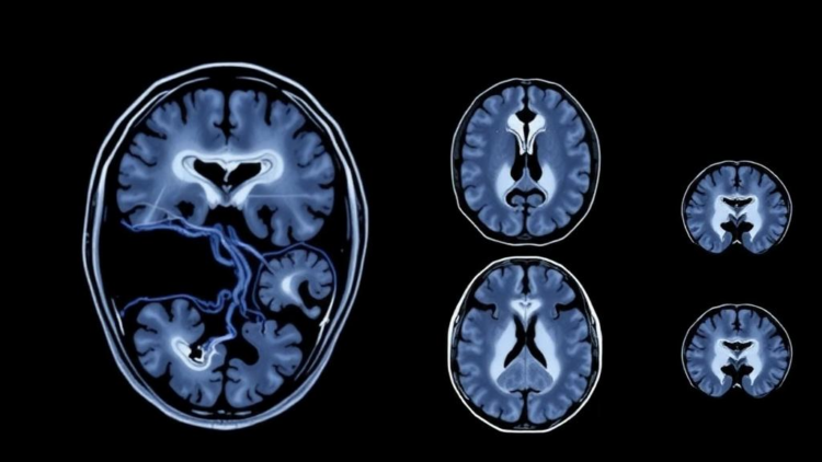 AI Reads Routine MRI Scans to Predict Survival in Children with Brain Cancer