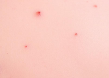 Skin Disease, Silent Metabolism: Large Database Study Links Hidradenitis Suppurativa to Type 2 Diabetes