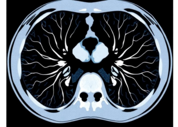 Chest CT Scans Get Sharper and Cleaner as Iterative Reconstruction Levels Rise