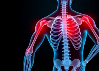 Low Muscle Mass Linked to Higher Osteoporosis Risk in Type 2 Diabetes Patients
