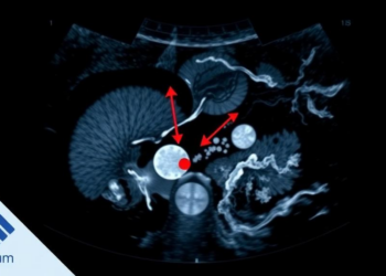 Hidden Liver Lesions Reveal Their Secrets to Contrast Ultrasound in Landmark Study