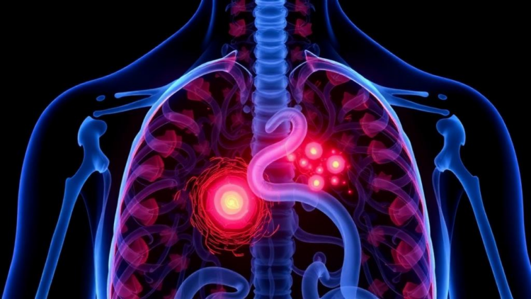 AI Reads the Tumor and Its Surroundings to Predict Surgery Risks in Thymoma Patients