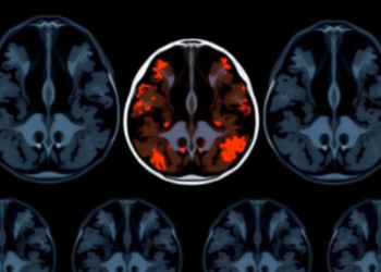 AI Reads Breast MRI Scans to Predict Cancer Recurrence Risk Before Surgery