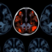 AI Reads Breast MRI Scans to Predict Cancer Recurrence Risk Before Surgery