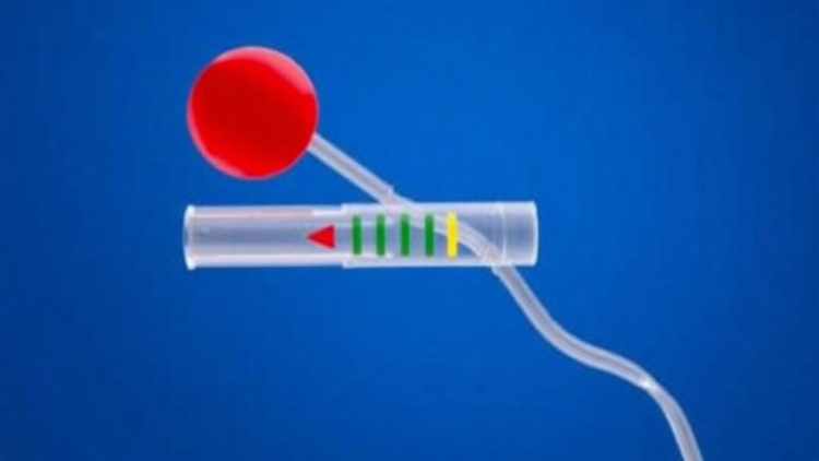 Simple DNA Biosensor Delivers Rapid Screening for Southeast Asian α-Thalassemia Deletion