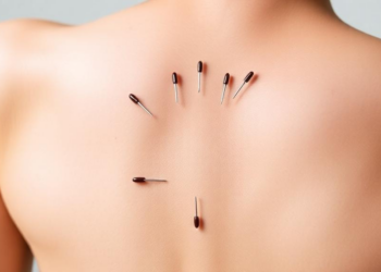 Needles and Nerves: Trial Puts Electroacupuncture to the Test Against Post-Prostatectomy Erectile Dysfunction
