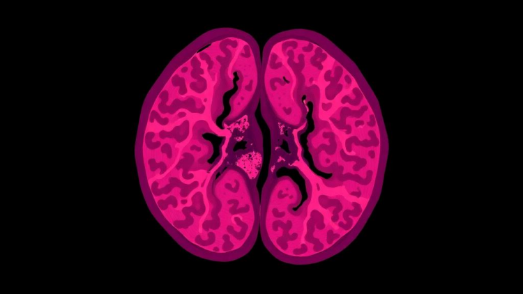 Advanced stage at diagnosis and aggressive histology dominate prostate cancer presentation in Kenya: a registry analysis
