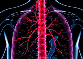 Hodgkin Lymphoma That Wrapped Around the Aorta and Invaded the Spine — and Chemotherapy Alone Cured It