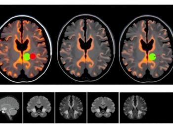 MRI Fusion Reveals Hidden Radiation Targets in Skull-Adjacent Brain Metastases