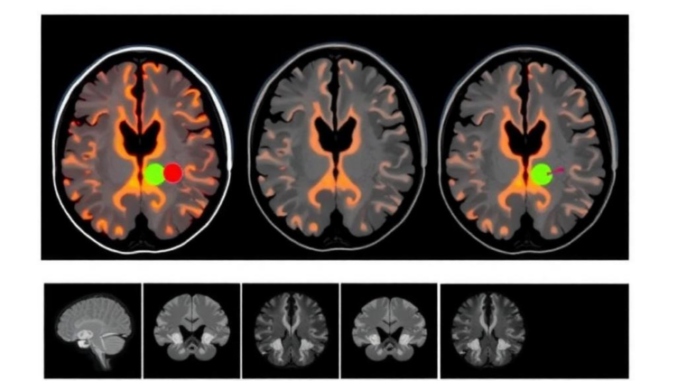 MRI Fusion Reveals Hidden Radiation Targets in Skull-Adjacent Brain Metastases