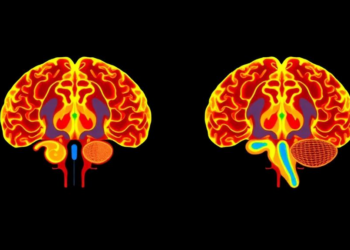 First hemisphere implantation reshapes thalamic stimulation maps in Essential Tremor