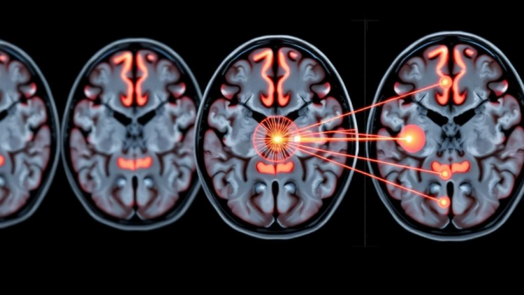 Physicists Borrow Quantum Mechanics to Map Brain Tumors on MRI Scans