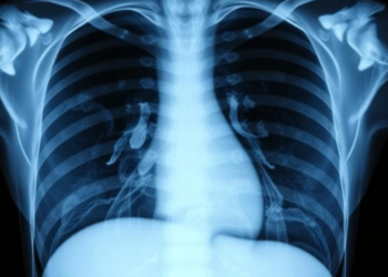 AI Turns Chest X-rays into Draft Radiology Reports with a Two-Stage Keyword Pipeline