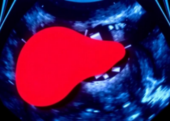 Simple Blood-Based Scores Outperform Ultrasound Expectations in Spotting Fatty Liver Among Diabetes Patients