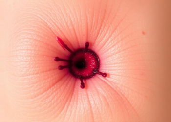Hidden Tumor Spread: Mapping Biopsies Guide Surgery for Recurrent Skin Cancer