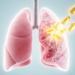 Antifibrotic Drug Pirfenidone Cuts Lung Injury Risk in Immunotherapy-Treated Lung Cancer Patients