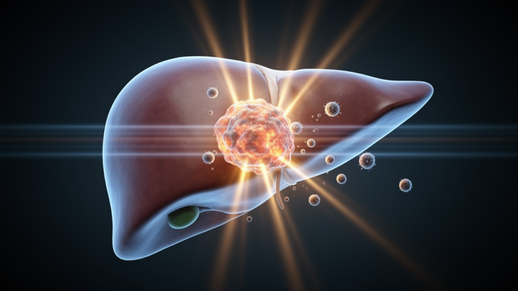 Radiation Before Transplant: Two Bridging Therapies Prove Safe but Imaging Falls Short in Liver Cancer
