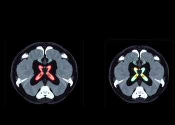 AI Reconstruction Cuts CT Radiation Dose in Half Without Sacrificing Image Quality