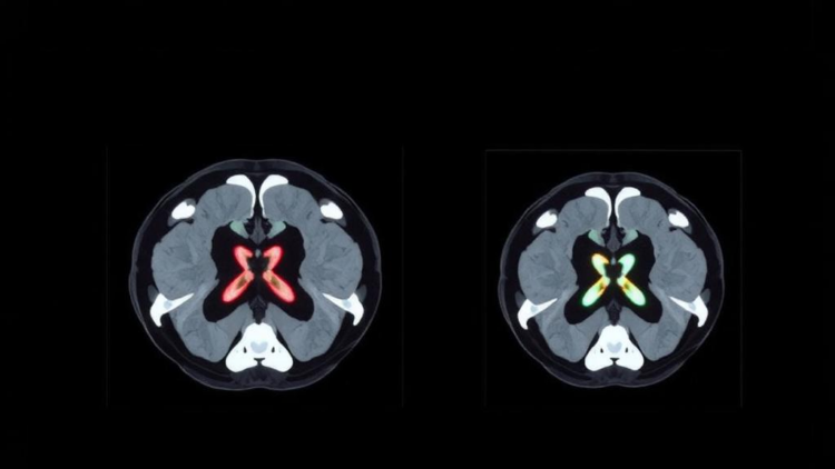 AI Reconstruction Cuts CT Radiation Dose in Half Without Sacrificing Image Quality