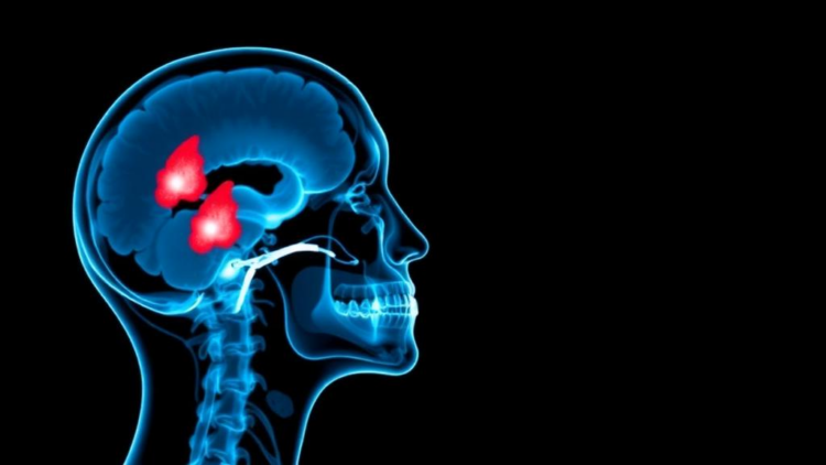 AI Helps Radiologists Diagnose Tricky Salivary Gland Tumors in Landmark Prospective Trial