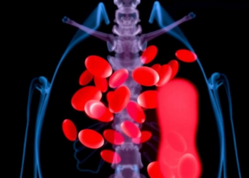 Gallstones in a Seven-Year-Old Revealed Hidden Blood Disorder, Prompting New Diagnostic Algorithm