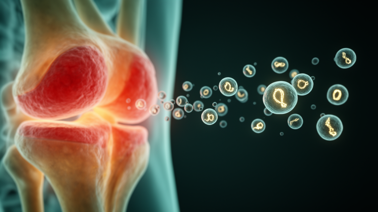 Stem Cell Exosomes Carrying a Circular RNA May Worsen Rheumatoid Arthritis, Study Finds