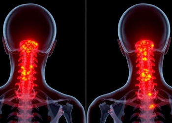 Rare Dual Abscess Case Shows How Staph Invades the Spine in Critically Ill Elderly Patients
