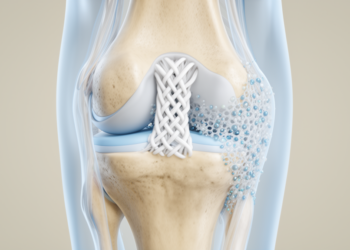Engineered PET Scaffolds Show Promise for Synthetic ACL Reconstruction