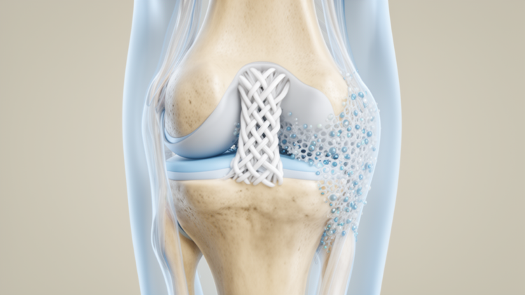Engineered PET Scaffolds Show Promise for Synthetic ACL Reconstruction