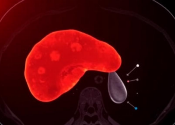 AI Learns to Trace Liver Tumors on CT Scans with New Attention-Powered Network