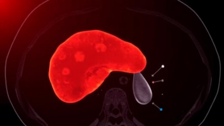 AI Learns to Trace Liver Tumors on CT Scans with New Attention-Powered Network