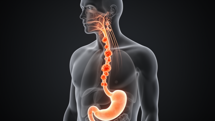 How a ‘Low-Risk’ Esophageal Cancer Defied the Rules and Struck the Neck Within Months