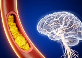 Vulnerable Carotid Plaques Quietly Damage the Brain’s White Matter, Study Finds