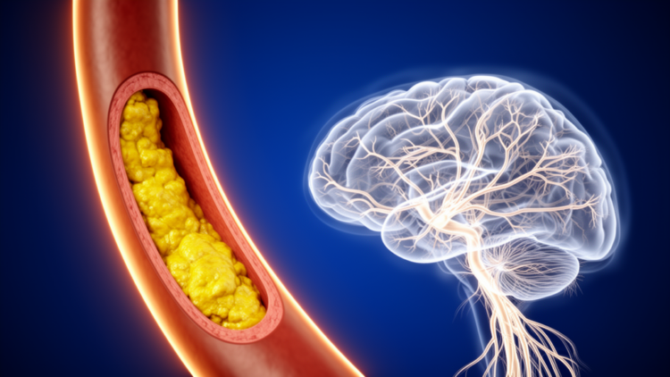 Vulnerable Carotid Plaques Quietly Damage the Brain’s White Matter, Study Finds