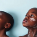 Skin-Deep Wounds: Study Probes Psychiatric Toll of Vitiligo in Black Children