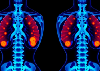 New Nomogram Predicts Hidden Lymph Node Spread in Early Thyroid Cancer Before Surgery