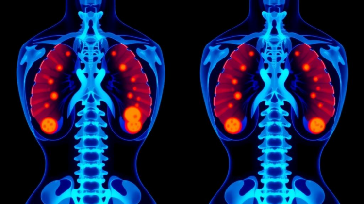 New Nomogram Predicts Hidden Lymph Node Spread in Early Thyroid Cancer Before Surgery
