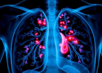 Immune Therapy Plus Chemotherapy Erases Stage IIIB Lung Tumor Before Surgery