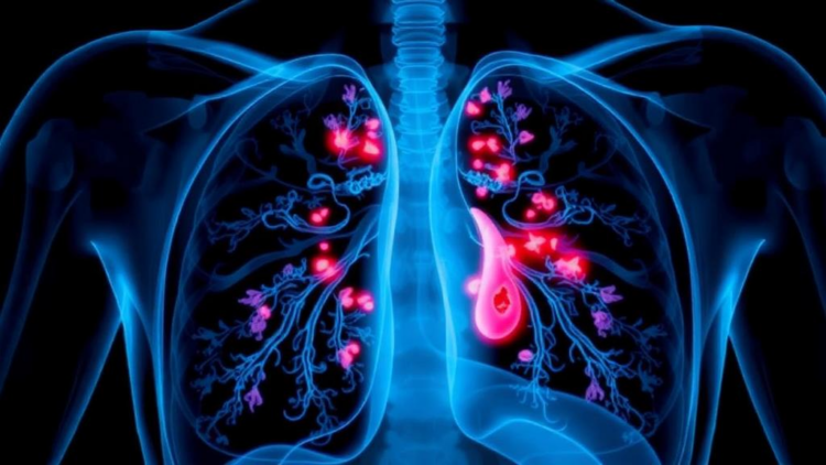 Immune Therapy Plus Chemotherapy Erases Stage IIIB Lung Tumor Before Surgery