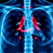 Delaying Radiotherapy May Boost Survival in Inoperable Oesophageal Cancer, Landmark Study Finds