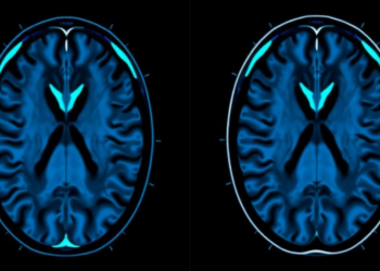 AI Turns Routine Neck MRI Scans Into Numbers to Track Disc Degeneration