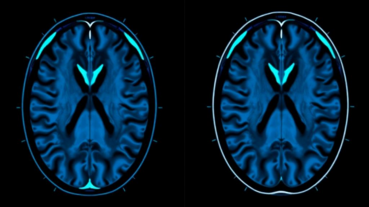AI Turns Routine Neck MRI Scans Into Numbers to Track Disc Degeneration