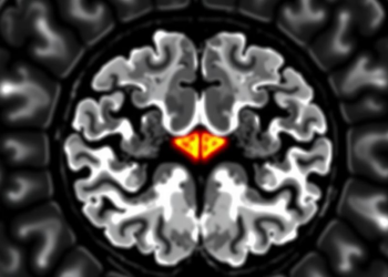 AI-Generated Contrast MRI Falls Short in Glioma Diagnosis, Study Finds