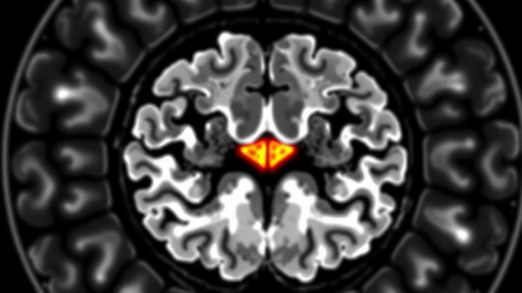 AI-Generated Contrast MRI Falls Short in Glioma Diagnosis, Study Finds