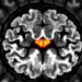 AI-Generated Contrast MRI Falls Short in Glioma Diagnosis, Study Finds