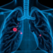 Hidden Lung Threat: Texas Hospital Data Reveal Uneven Burden of Hard-to-Treat Mycobacterial Disease